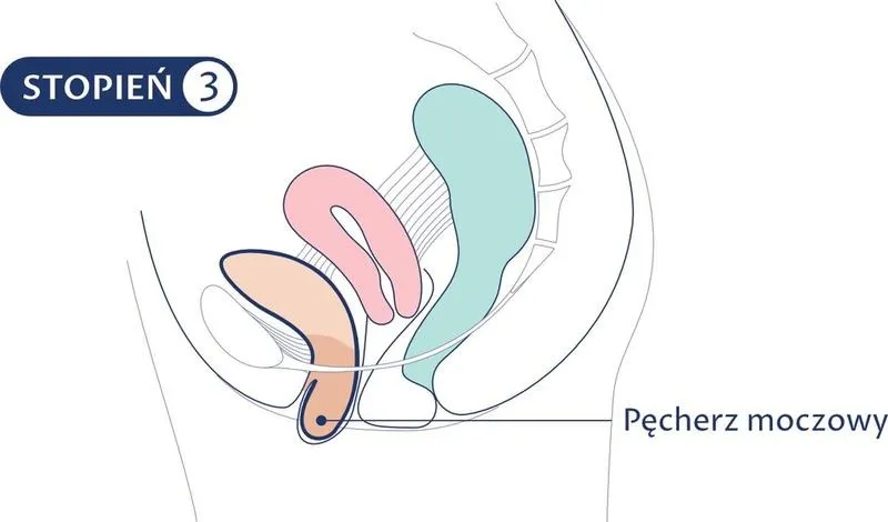 Obniżenie ścian pochwy po porodzie – doświadczenia i opinie kobiet na forum